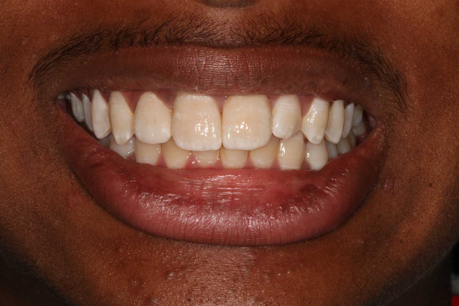 Post-Traumatic Presentation | Nova Prosthodontics