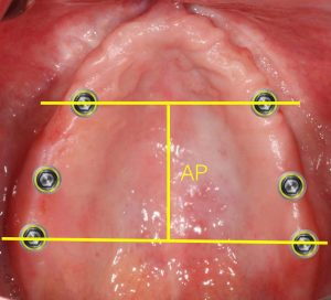 Maxillary Tapering Arch | Nova Prosthodontics
