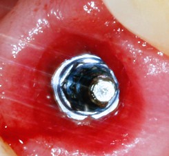 Fractured Implant Abutment Screws | Nova Prosthodontics
