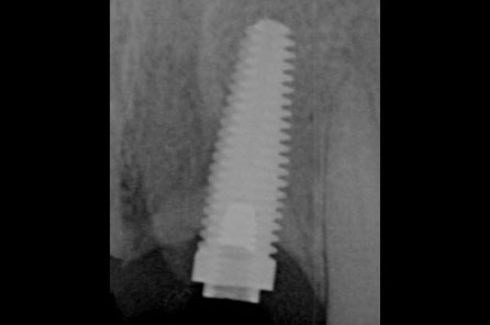 Fractured Implant Abutment Screws | Nova Prosthodontics