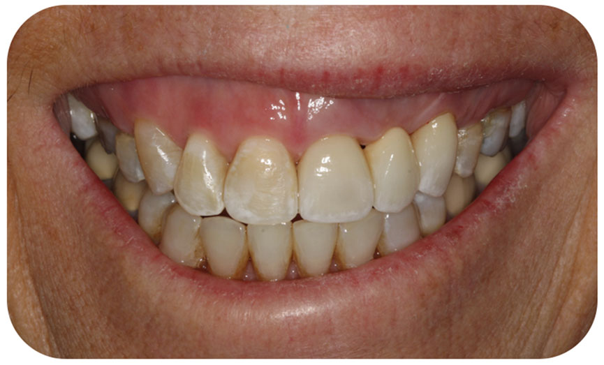 How to diagnose a gummy Smile | Nova Prosthodontics