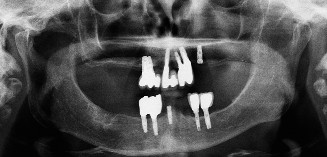 Comprehensive Implant Treatment | Nova Prosthodontics