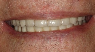 Comprehensive Implant Treatment | Nova Prosthodontics