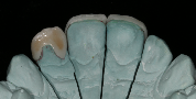 Post-Traumatic Presentation | Nova Prosthodontics