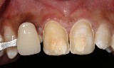 Post-Traumatic Presentation | Nova Prosthodontics