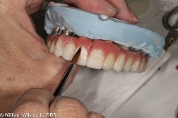 REPAIR OF FRACTURED PORCELAIN | Nova Prosthodontics