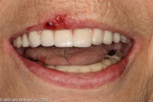 REPAIR OF FRACTURED PORCELAIN | Nova Prosthodontics