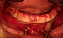 Implant Planning and Surgical Guides | Nova Prosthodontics