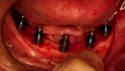 Implant Planning and Surgical Guides | Nova Prosthodontics