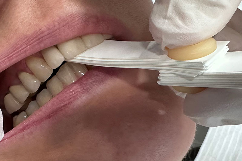 Occlusal Device Fabrication | Nova Prosthodontics