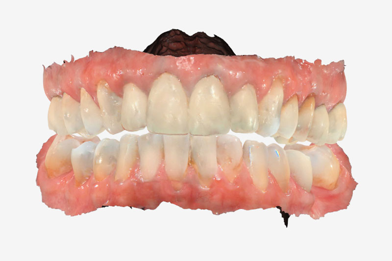 Occlusal Device Fabrication | Nova Prosthodontics