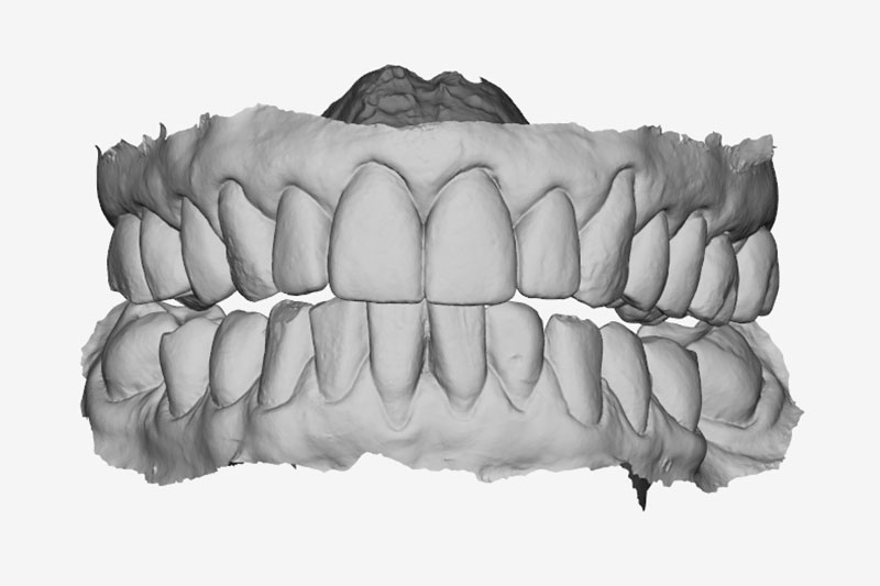 Occlusal Device Fabrication | Nova Prosthodontics