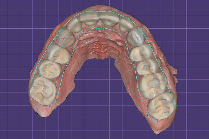 Occlusal Device Fabrication | Nova Prosthodontics