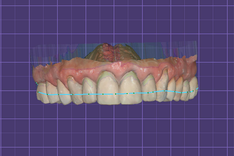 Occlusal Device Fabrication | Nova Prosthodontics