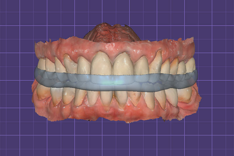 Occlusal Device Fabrication | Nova Prosthodontics