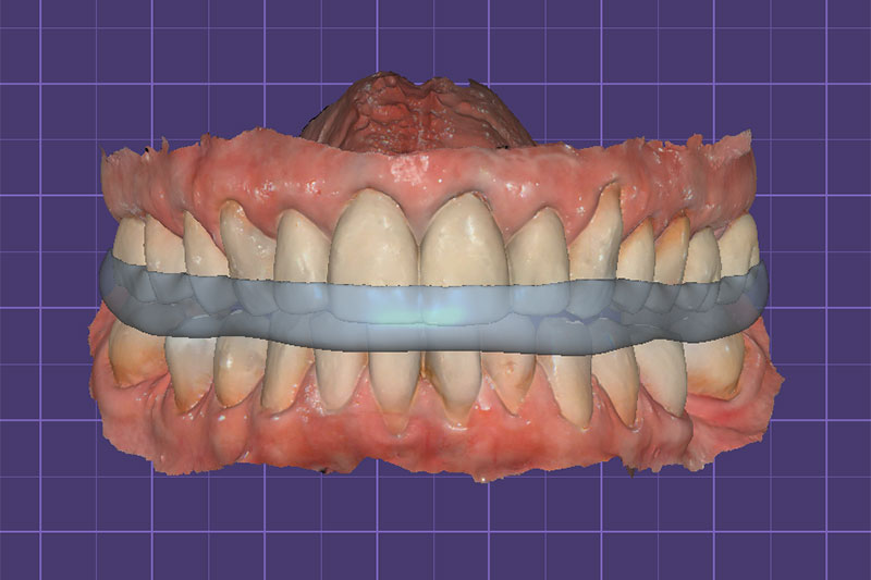 Occlusal Device Fabrication | Nova Prosthodontics